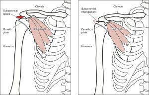 Kids shoulder pain- picture of the shoulder blade where tight muscles can pull and reduce space for other muscles to work