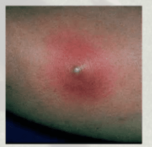 Spider Bites: Picture of a skin infection in an athlete