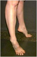Limitations in big toe dorsiflexion, known as hallux rigidus