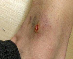 picture of an open wound from figure skate boot rubbing against the ankle causing a figure skating skin injury