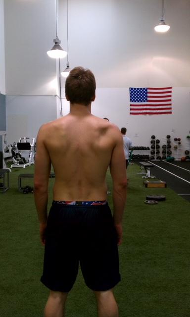 Volleyball Shoulder: picture of high level volleyball player with muscle loss around his right shoulder blade