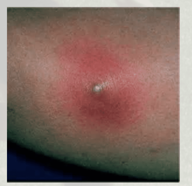 Spider Bites Scary Skin Staph Stuff Orange County Pediatric And