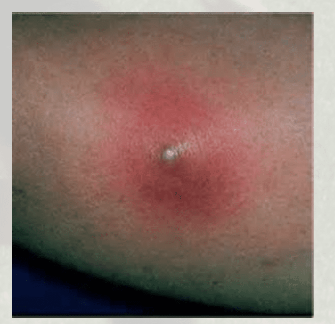 Spider Bites: Scary Skin Staph Stuff