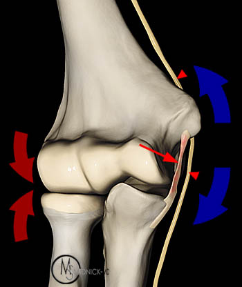Elbow Pain in Baseball Players diagram