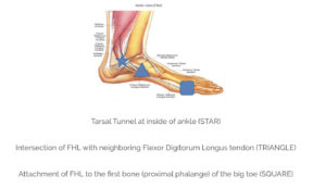 Tarsal Tunnel