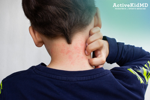 active kid md how to treat eczema in kids