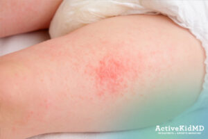 active kid md solid food skin rash