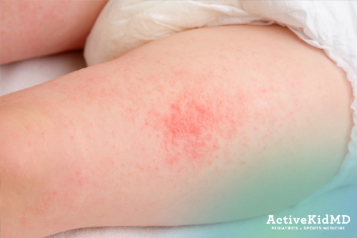 active kid md solid food skin rash